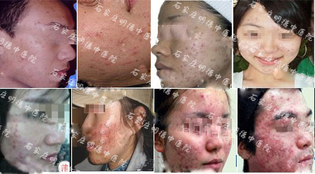 石家庄明德中医院皮肤科