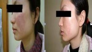 荨麻疹患者重生记 感谢华医融化了“冰窟窿”