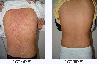 体癣案例