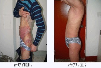 股癣治疗前后对比