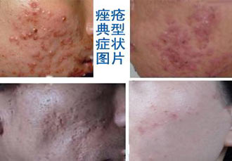 痤疮怎么快速去除