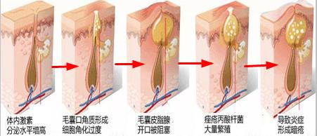痤疮形成过程病理图